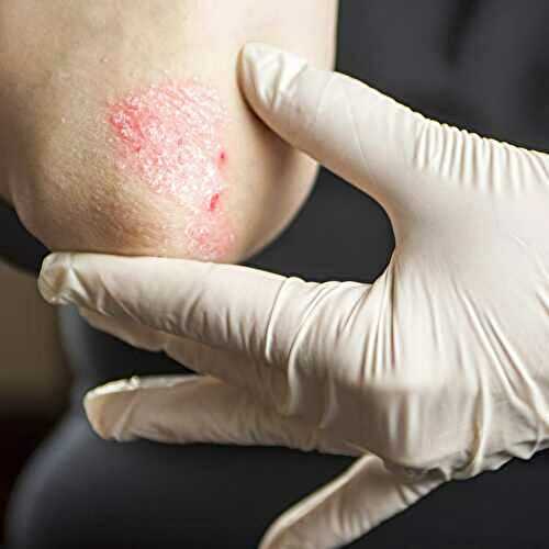 How to tell the Different Types of Psoriasis